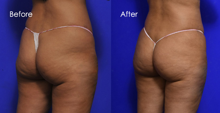 before and after brazilian butt lift
