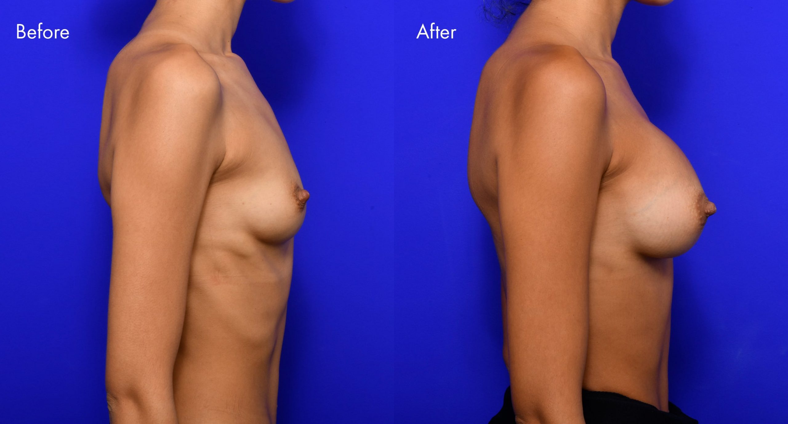 Breast Augmentation Before and After | 9