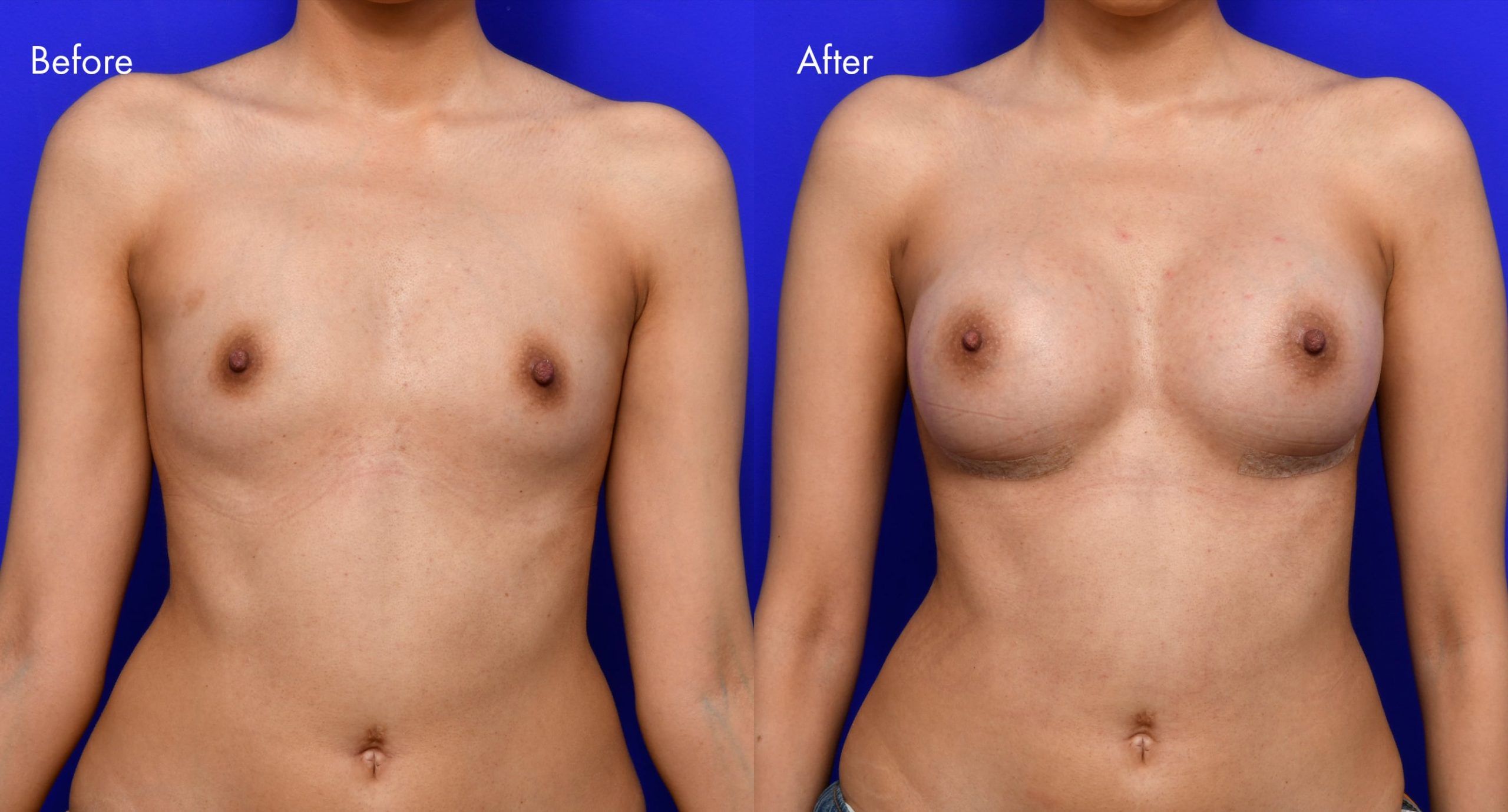 Breast Augmentation Before and After | 11